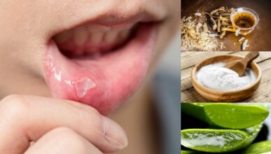 10 Natürliche Hausmittel gegen Mundgeschwüre