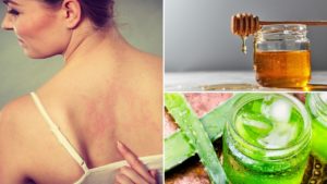 Mehr über den Artikel erfahren 10 Natürliche Hausmittel gegen Dermatitis