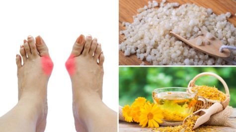 Du betrachtest gerade 10 Natürliche Hausmittel gegen Hallux valgus