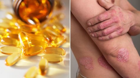 Du betrachtest gerade Hilft die Einnahme von Omega-3 bei Psoriasis?