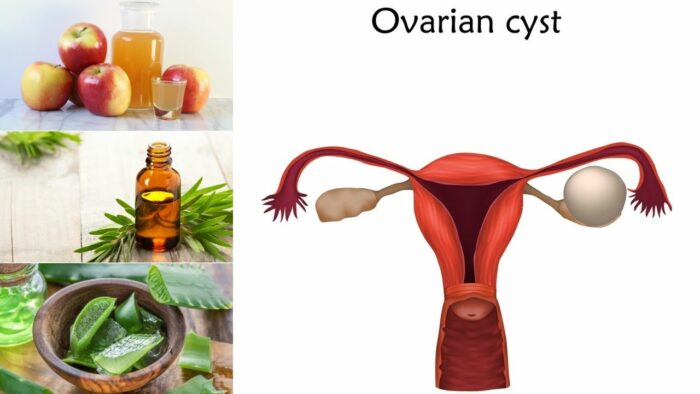 Du betrachtest gerade 10 Natürliche Hausmittel gegen Vaginalzysten