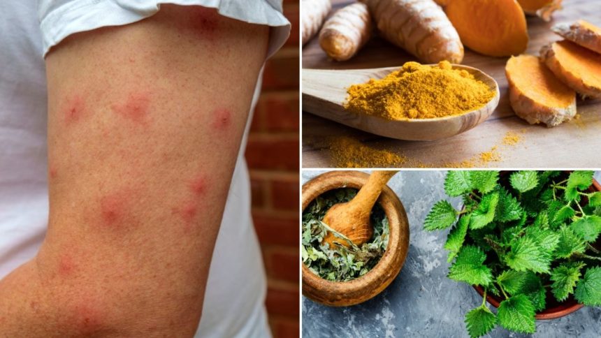 10 Natürliche Hausmittel für eine allergische Reaktion - Gesunde Wahrheit