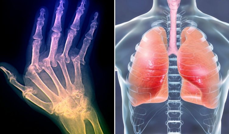 Wie sich rheumatoide Arthritis auf die Lunge auswirkt