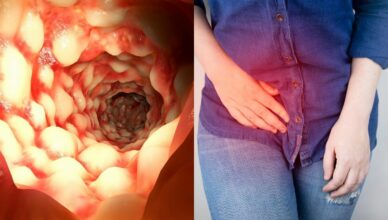 Morbus Crohn Symptome: Frühe Anzeichen und Komplikationen