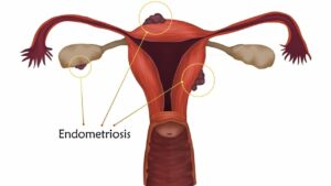 Mehr über den Artikel erfahren Endometriose: Symptome, Ursachen und Behandlung