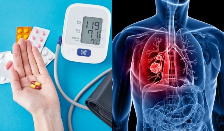 Studie: Blutdruckmedikament erhöht das Lungenkrebsrisiko