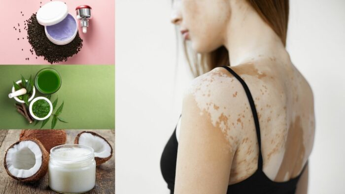 Du betrachtest gerade 10 Natürliche Hausmittel gegen Vitiligo (Weißfleckenkrankheit)