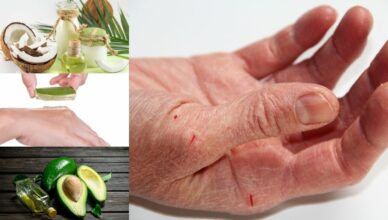 10 Natürliche Hausmittel gegen trockene Hände