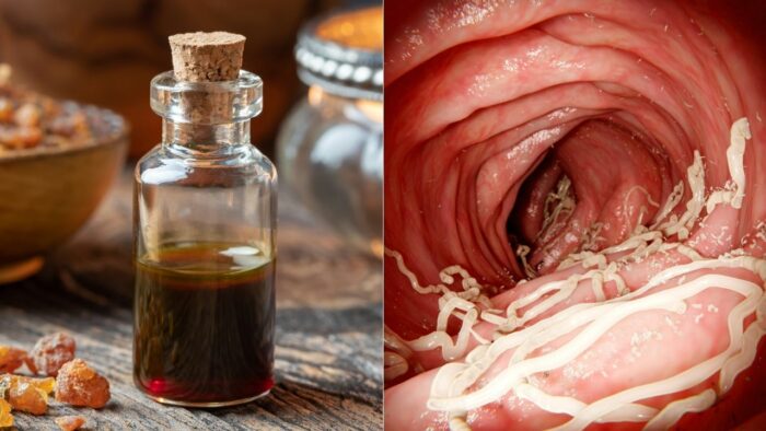 Du betrachtest gerade Myrrhe Öl wirkt antibakteriell und bekämpft Parasiten