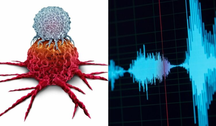 Wissenschaftler haben einen Weg gefunden, Krebstumore mit Schallwellen zu zerstören