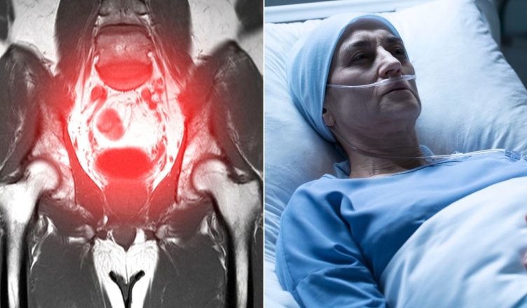 Ärztin stirbt an Krebs nachdem eine Operation Krebszellen in ihrem ganzen Körper verbreitet hat