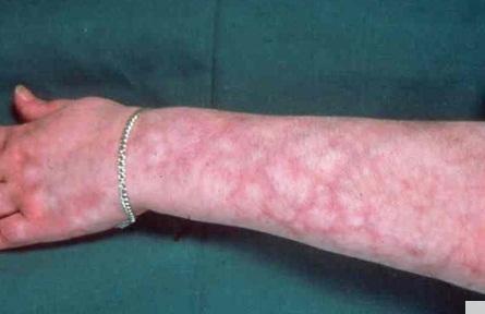 Lacey Modeled Rash Kryoglobulinämie: Ursachen, Symptome und Behandlung - DGW