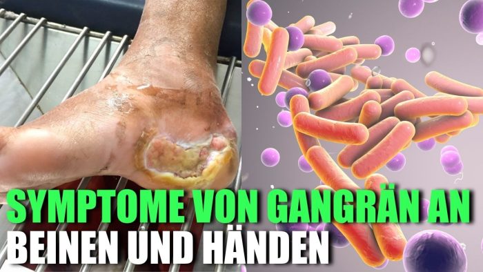 Du betrachtest gerade 6 Häufige Anzeichen und Symptome von Gangrän an Beinen und Händen