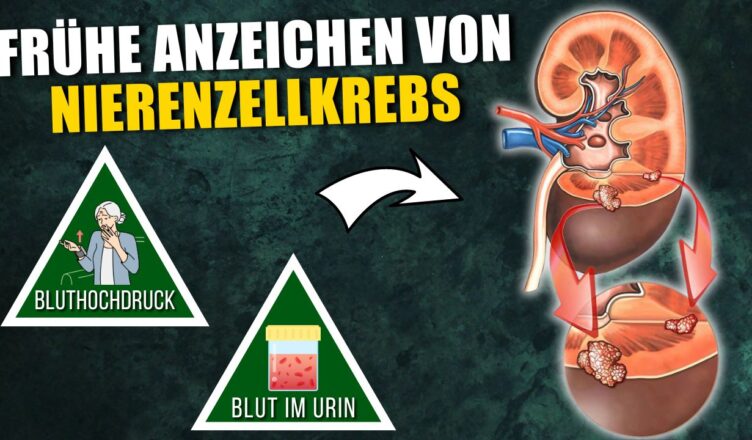 10 Frühe Anzeichen von Nierenzellkrebs, die du kennen musst